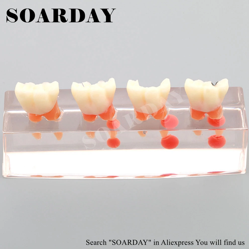 

SOARDAY Dental Endodontic Restoration Model Teaching Communication Model Pathological Display Dental Caries