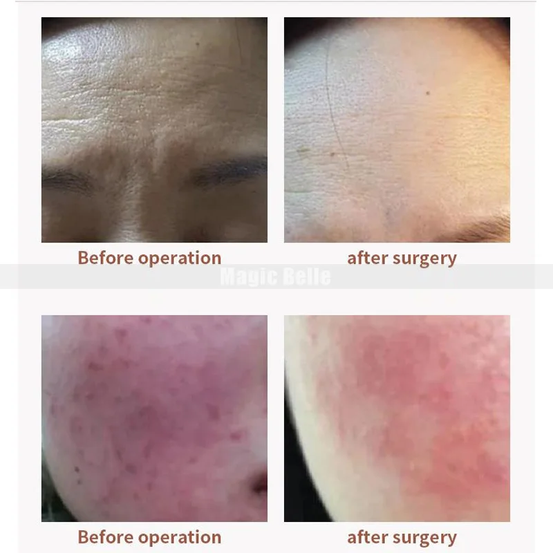 

2019 Best seller efficient penetration plasma jett anti- aging machine Whitening Plasma Jett for beauty salon acne