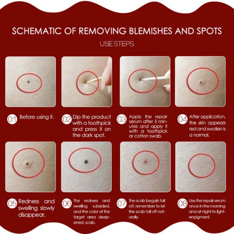 2 набора средство для удаления веснушек и бородавок|Устройство ухода за кожей