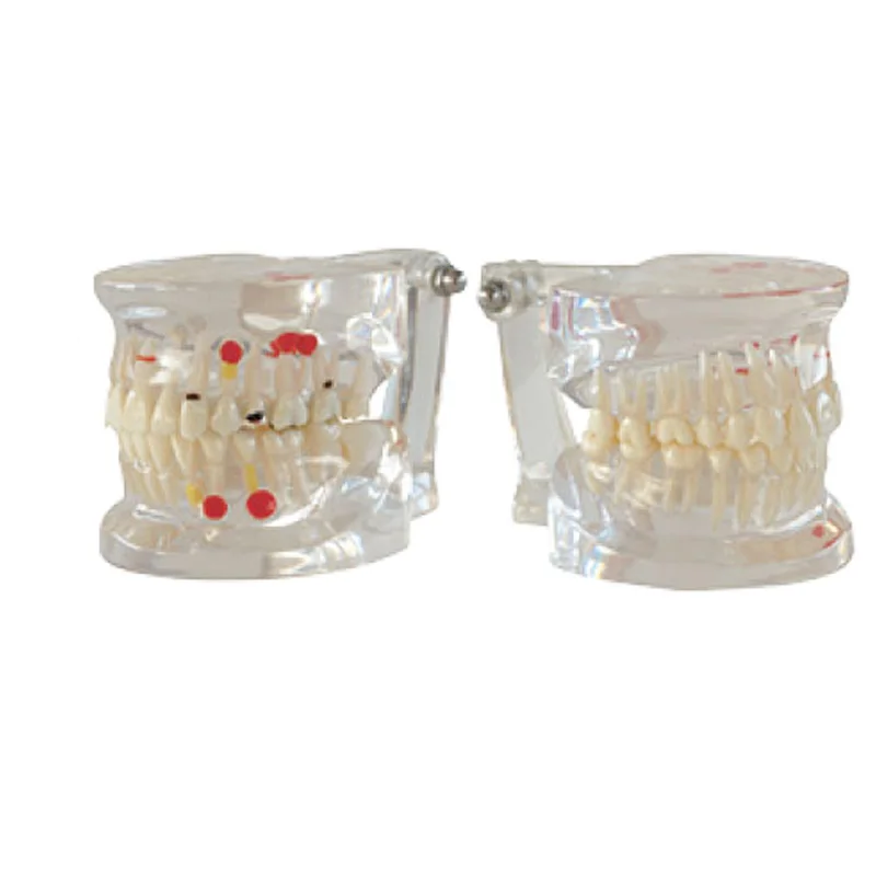 

Dental Implant Disease Teeth Model With Restoration Bridge Tooth Dentist For Medical Science removable Disease Teaching Study