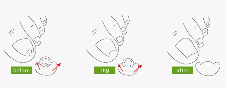 Педикюр вросший ноготь Ingrown Toe корректор для педикюра инструмент для ухода за ногами бандаж для ногтей набор машина для детоксикации Onyxis Bunion прецизионные кусачки для ног