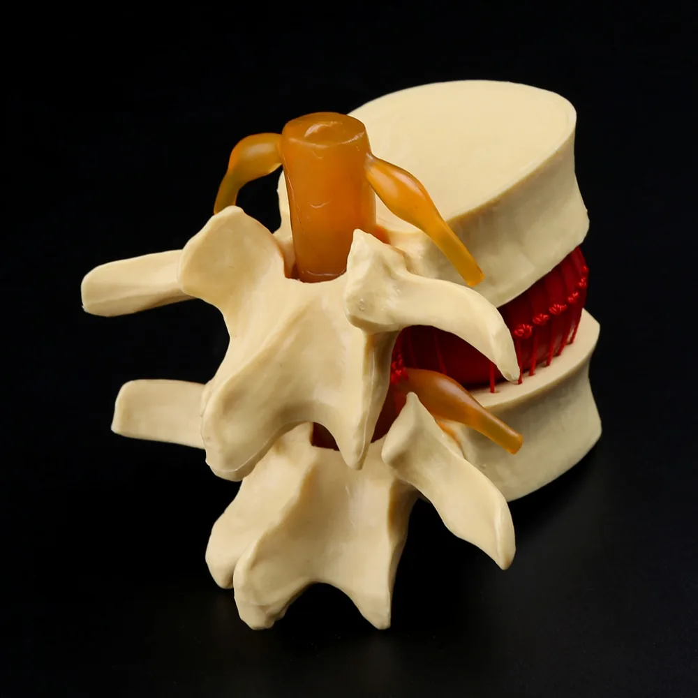 Anatomical Spine Lumbar Disc Herniation Anatomy Medical Model Teaching Tool School Supplies Instrume C26 | Канцтовары для офиса и