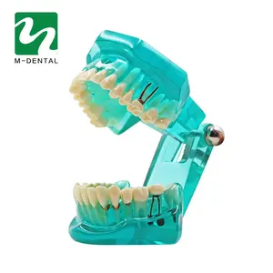 Модель имплантата Стоматологическая модель зубов, прозрачная, синяя, модель съемных зубов, инструмент для обучения зубам, для взрослых, для медицинских исследований