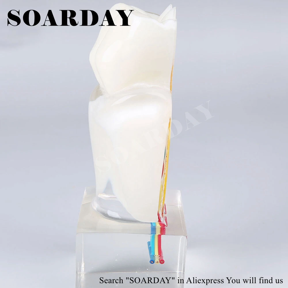 SOARDAY шестикратная модель анатомии зубного нерва патологическая