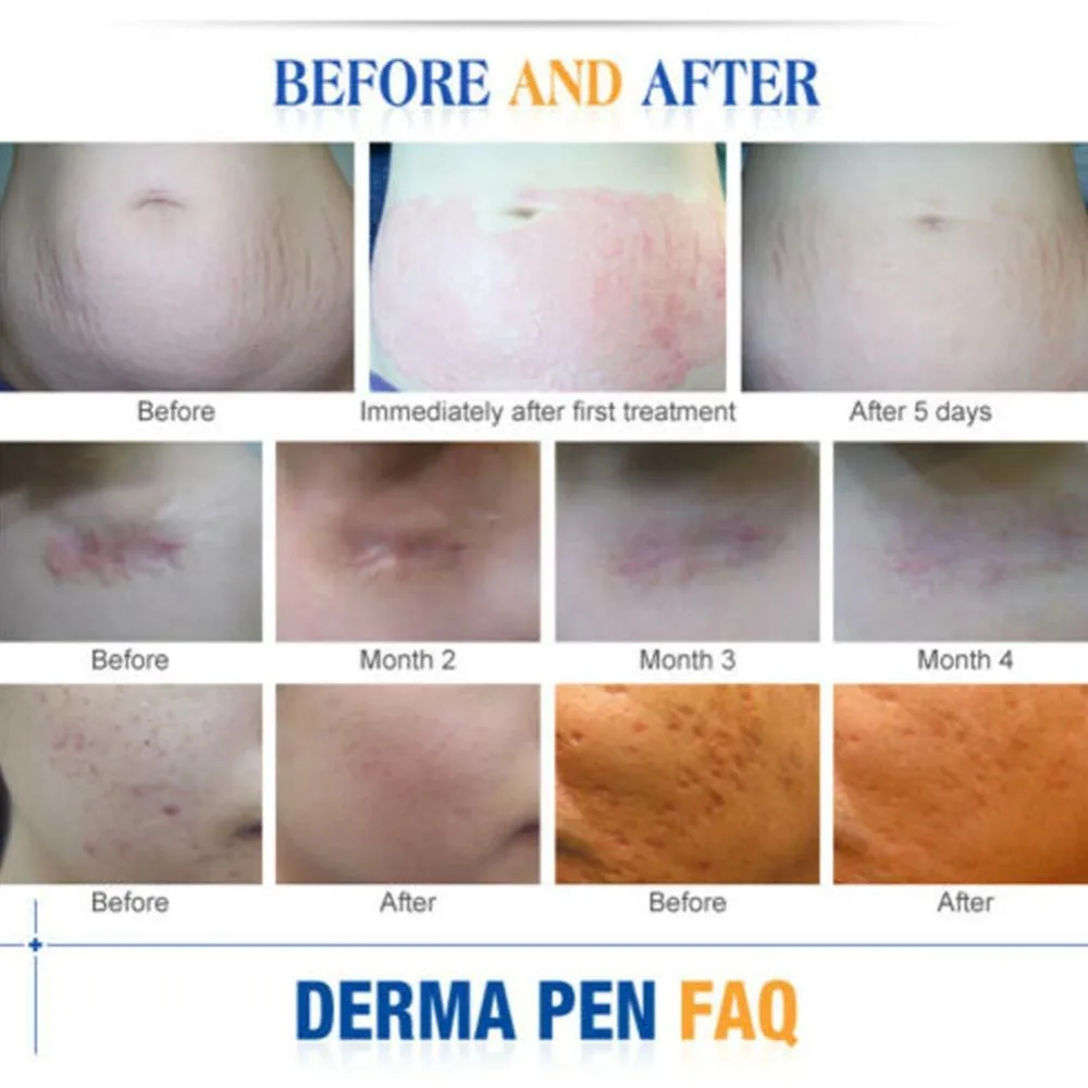 Прокатка Дерма штамп терапия Dr. pen Дерма ручка штык порт картридж иглы(в том числе 2 шт. x 12pin иглы) машина Электрический микро