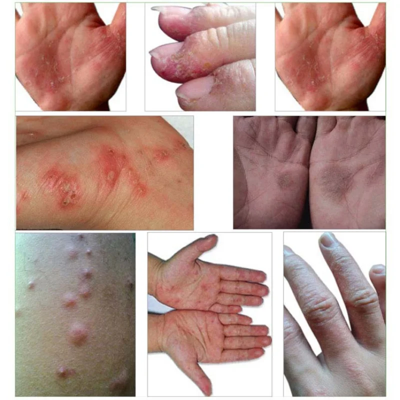 Полезный оригинальный псориаз дерматит рвота проблемы с кожей Крем Горячая