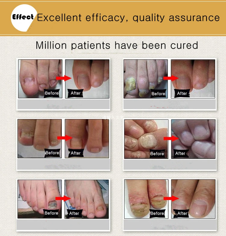 Эссенция для лечения Ногтей от грибков Dimollaure уход за ногтями ногами