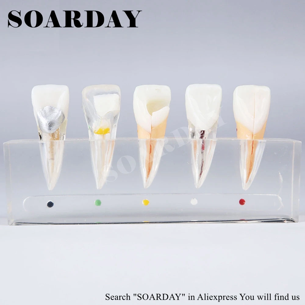 SOARDAY эндодонтическая реставрация модель обучения практики стоматолога пациента