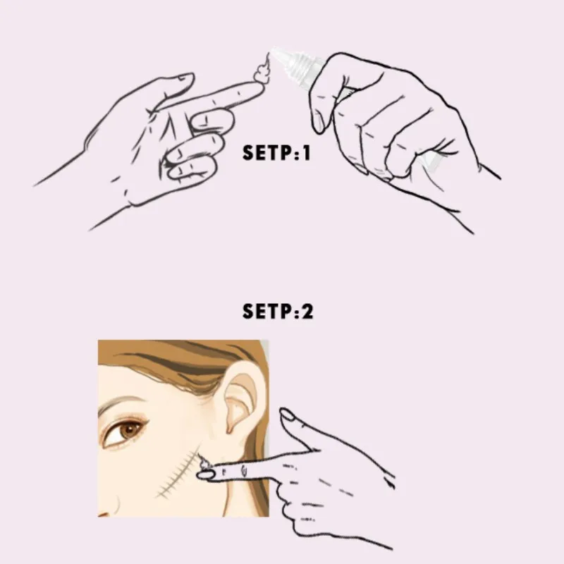 

2019 Face Repair Cream Acne Spots Acne Treatment Blackhead Whitening Cream Anti Scar Stretch Marks Acne Scar Removal Cream