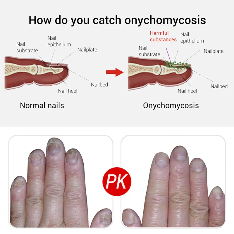 Ремонт ногтей гель грибковое Лечение Удаление онихомикоза ног Питательный Уход