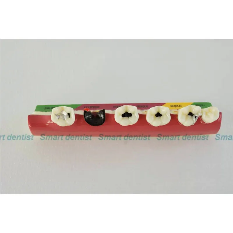

Dental Periodontal Disease Tooth Model Dental Caries Analysis Model DEASIN