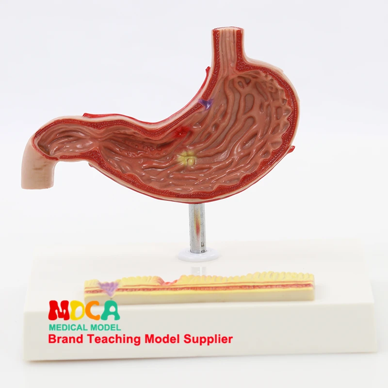 Pathological gastrointestinal model human gastric lesions teaching aids digestive system medicine MCW008 | Канцтовары для офиса и