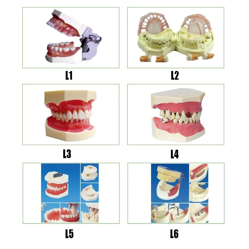 

Gingival Diseases teeth Model Peridontal Disease teeth Model Implant Practice Jaw Model