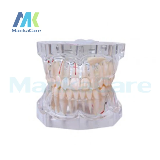 Manka Care - 2.5 Times Pathology Oral Model Teeth Tooth Model