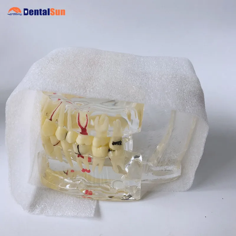 

Dental Tooth Model M4001/Adult Tooth Model with Pathologies