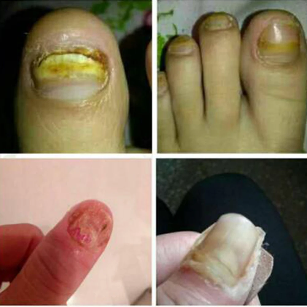 Грибок для ногтей/пароникья онихомикоза/грибковая инфекция ногтей хороший