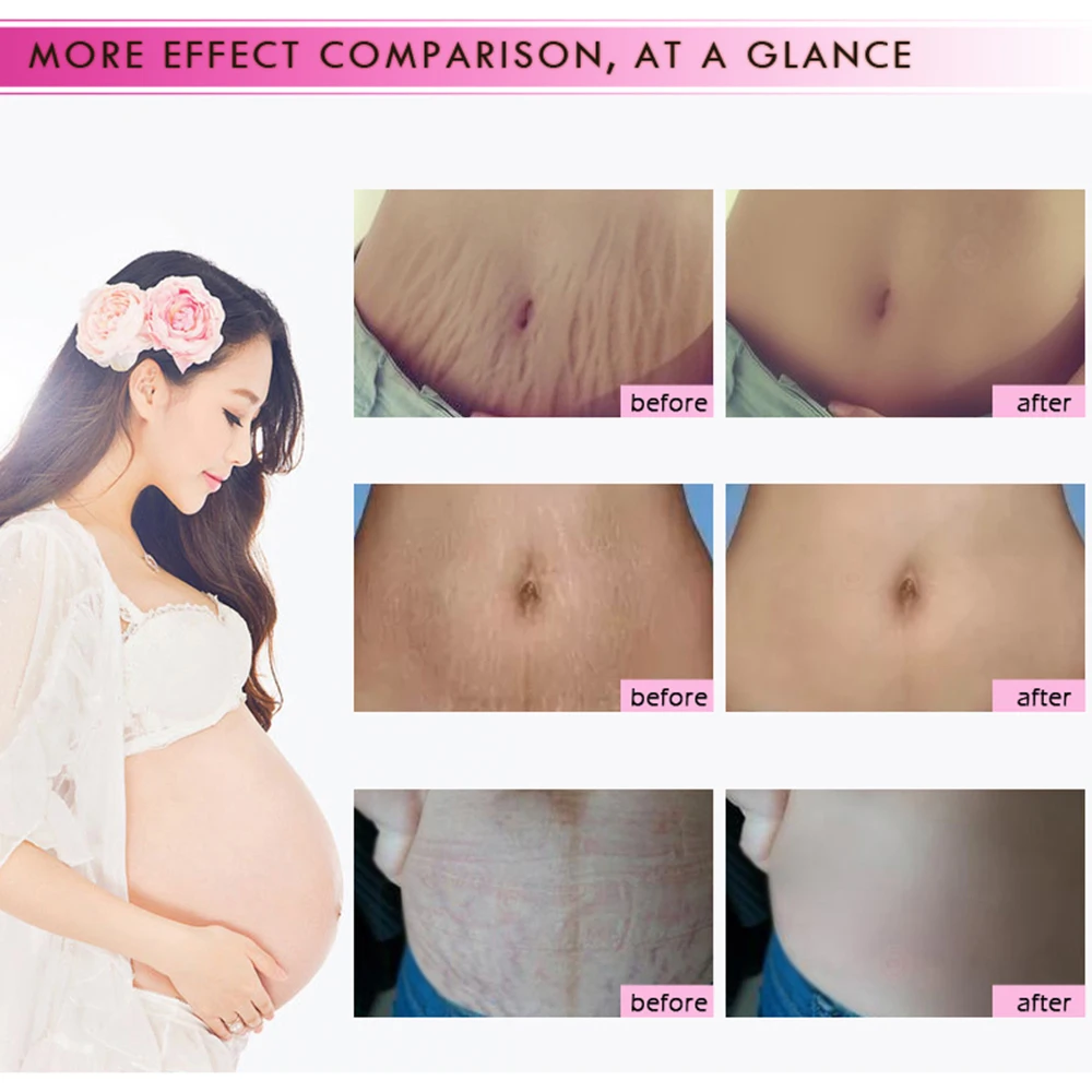 RtopR Natural Mild Non-irritating Mango Stretch Mark Cream Pregnancy Repair Scar Slack Line Abdomen Stretch Marks Cream TSLM1