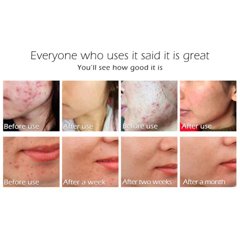 Женский противовоспалительный уход за кожей бесageless крем от акне лечение шрамов