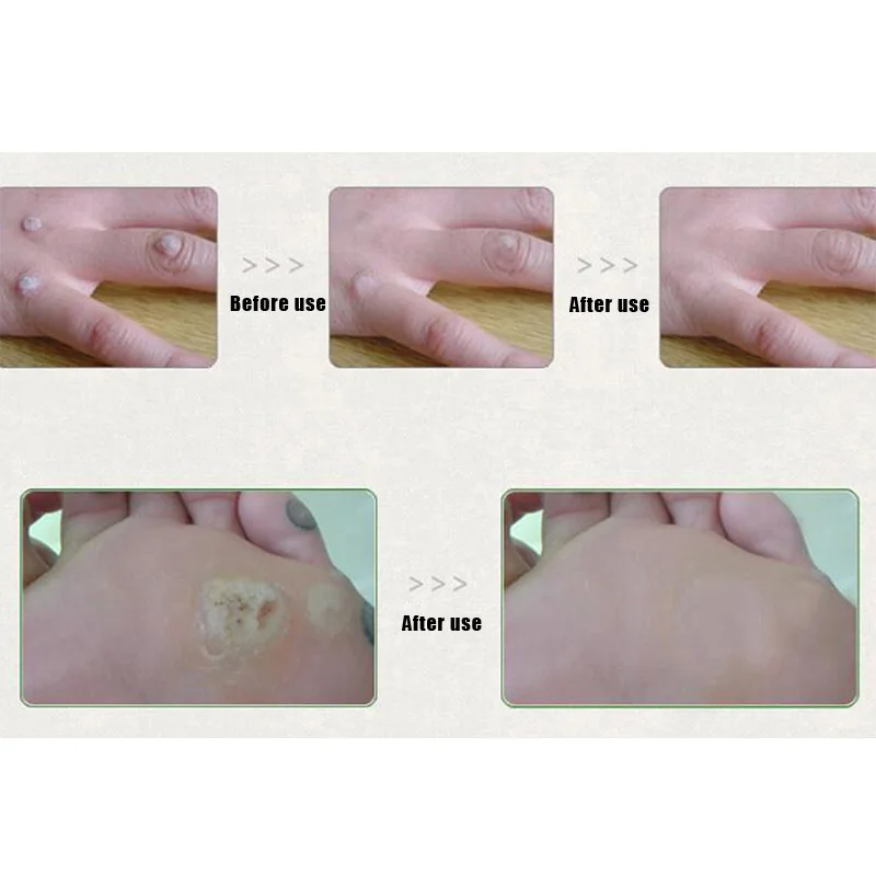 Жидкая дерматологическая жидкость для здорового образа кукурузы Ежика