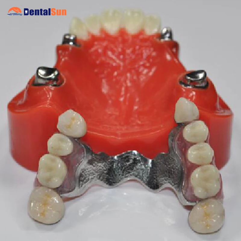 

Model with Restoration/Bridge/Onlay/Inlay/Implant/Steel