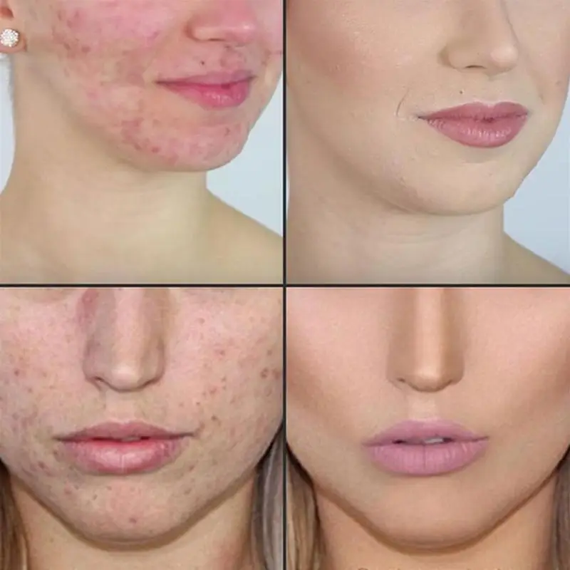 

Tree Pure Essential Oil Face Care Skin Acne Treatment Blackhead Remover Anti Scar Spots Massage Oil aceites esenciales