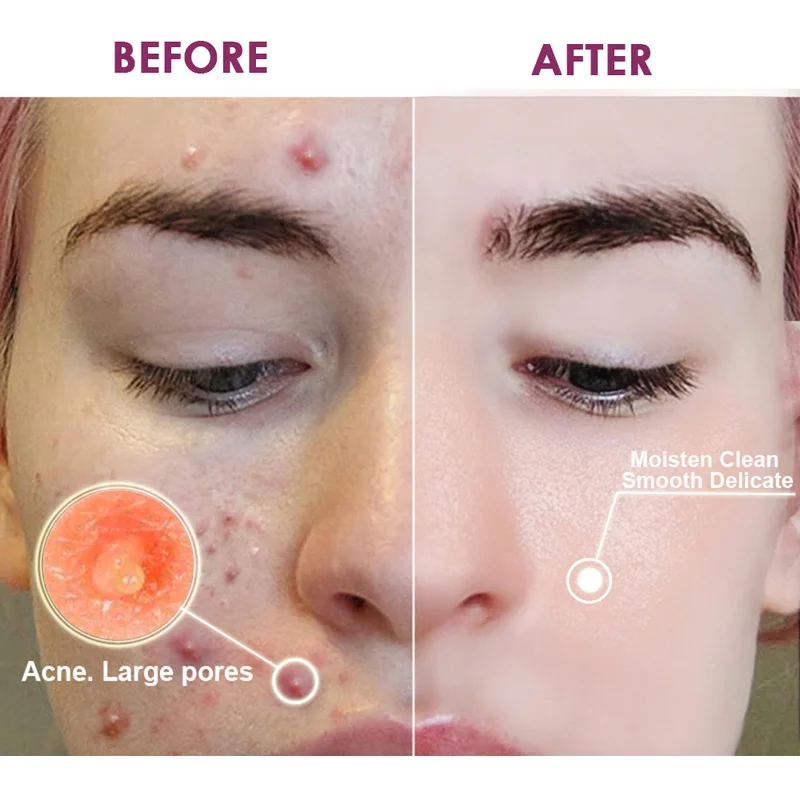 Сыворотка для восстановления прополиса осветляющая сыворотка лечения акне