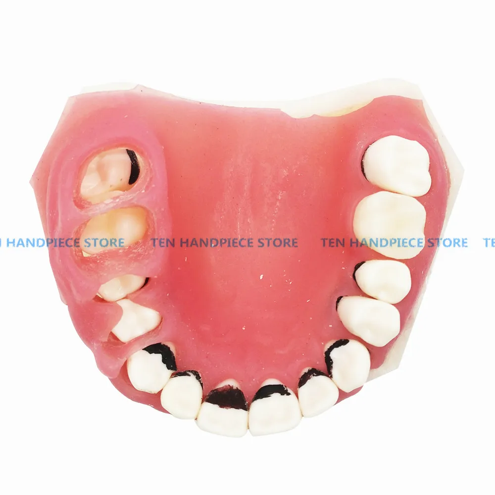 

2018 good quality Dental Periodontal Disease Model / Tooth Medical Model dentist learning model