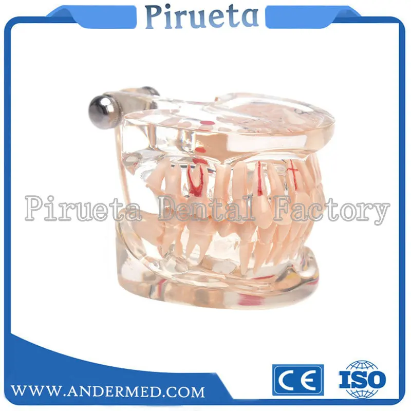 

1pcs Dental Implant Disease Teeth Model With Restoration Bridge Tooth Dentist For Medical Science Dental Disease Teaching Study