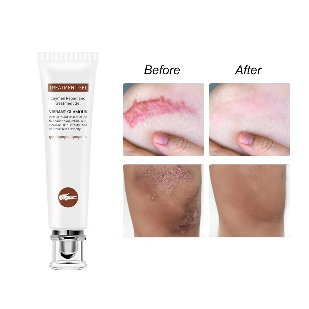 

Remove Pregnancy Scars Stretch Marks Removal Cream Anti Wrinkle Anti Aging Maternity Skin Repair Cream Treatment Body Care
