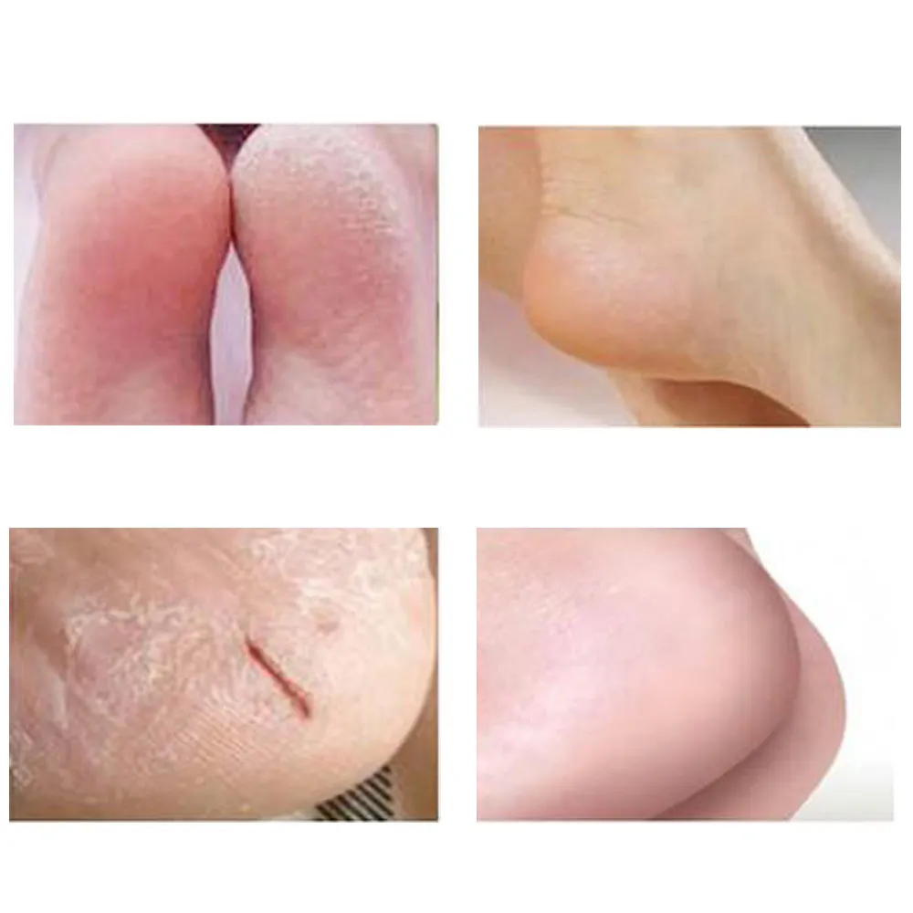 2 шт. силиконовые Увлажняющие гелевые носки с дырками|silicone moisturizing gel heel|silicone