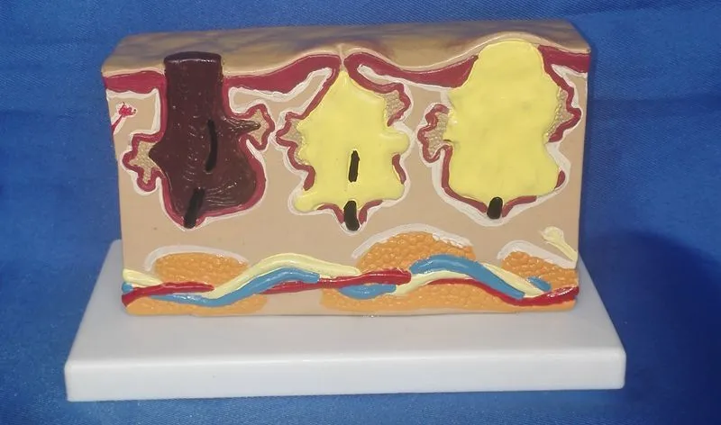

human body Skin cancer model Medical Teaching model free shipping