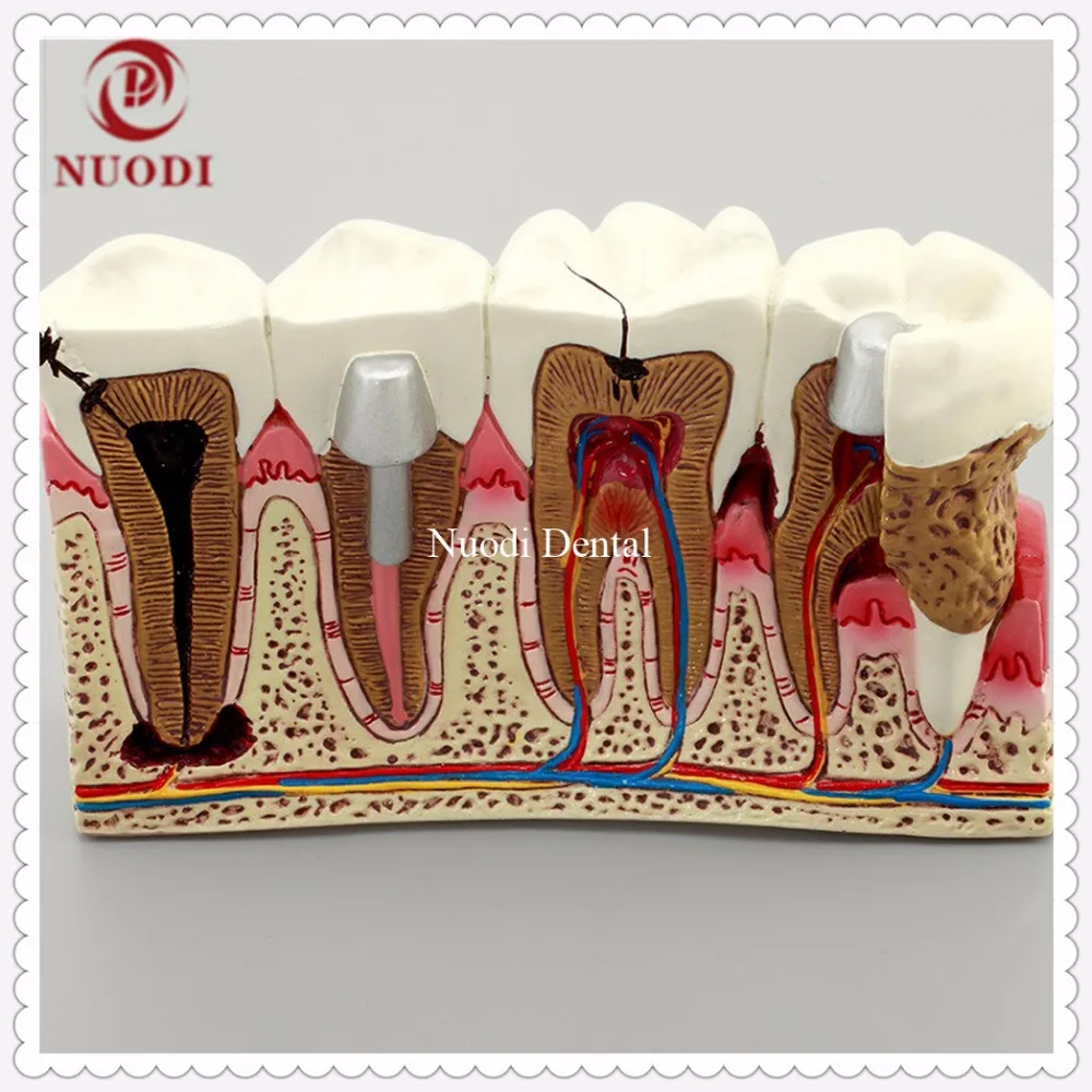 Dental Implant Teeth Model/Dentistry Disassembling Caries dental tooth Model/4times teeth model |