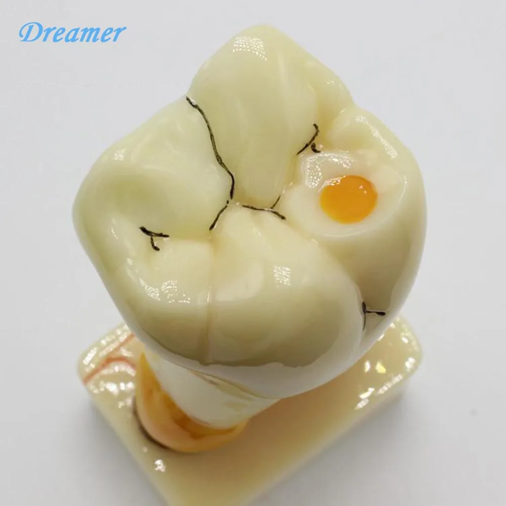 Модель анатомии для выполнения обычных патологий зубов модель кариес