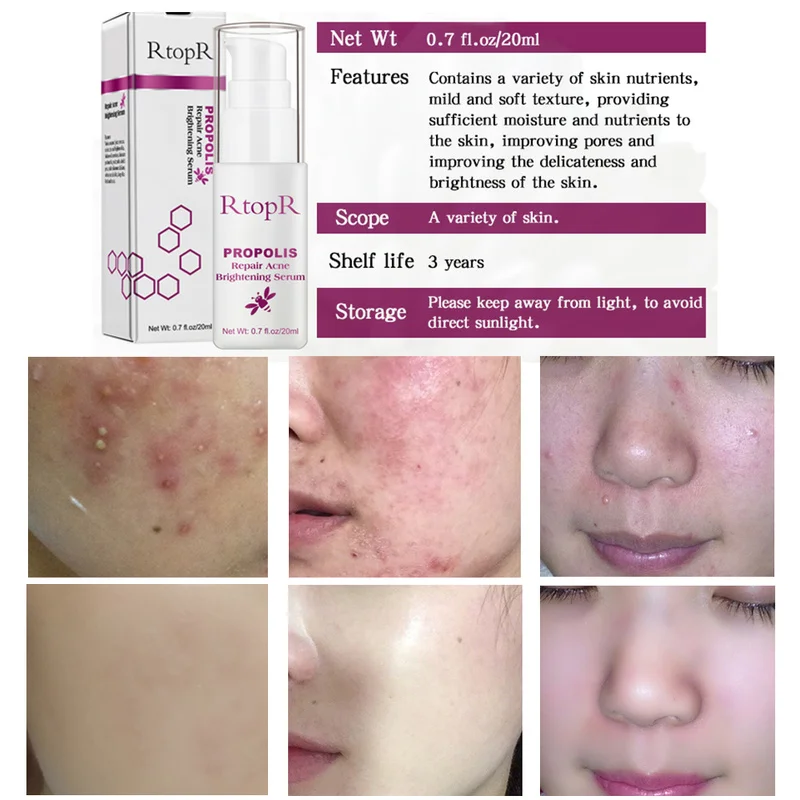 RtopR Propolis Repair Acne осветляющая сыворотка для удаления акне шрамовых пятен очищающая