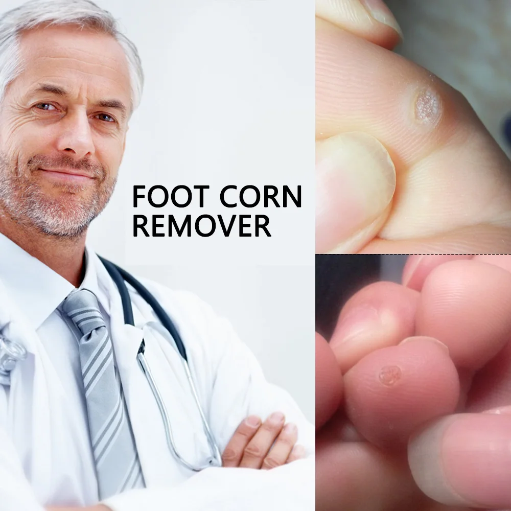 

42 Pcs Corn Removal Plaster Removal Warts Thorn Patches Corn of Foot Calluses Soften Skin Cutin Sticker Corn Removal Plaster