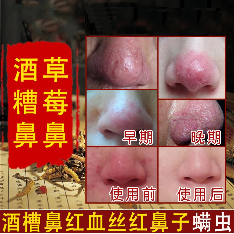 Средство против клещей в носу средство от красных черных точек на сужение пор