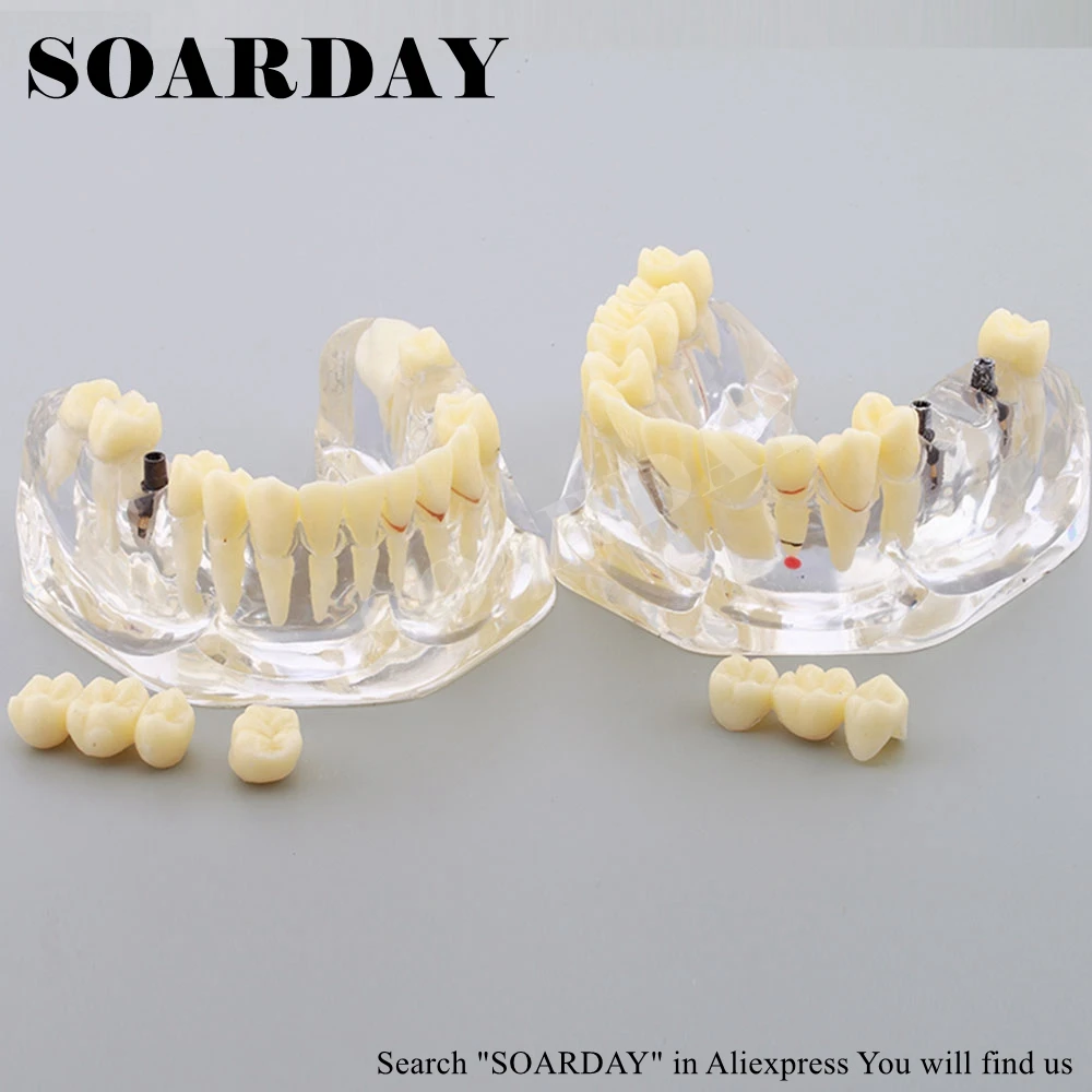 1 шт. стоматологическая патологическая модель импланта SOARDAY|bridge implant|implant modeldental