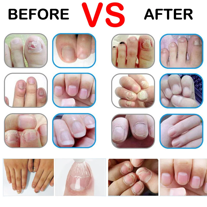 Good Result Nail Treatment Pen Onychomycosis Paronychia Anti Fungal Infection Chinese Herbal Toe Fungus | Красота и здоровье