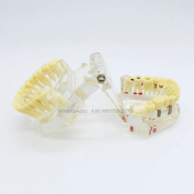 

Dental removeable Teeth Model dental activity pathological model Dental Implant Disease Teeth Model With Restoration Bridge