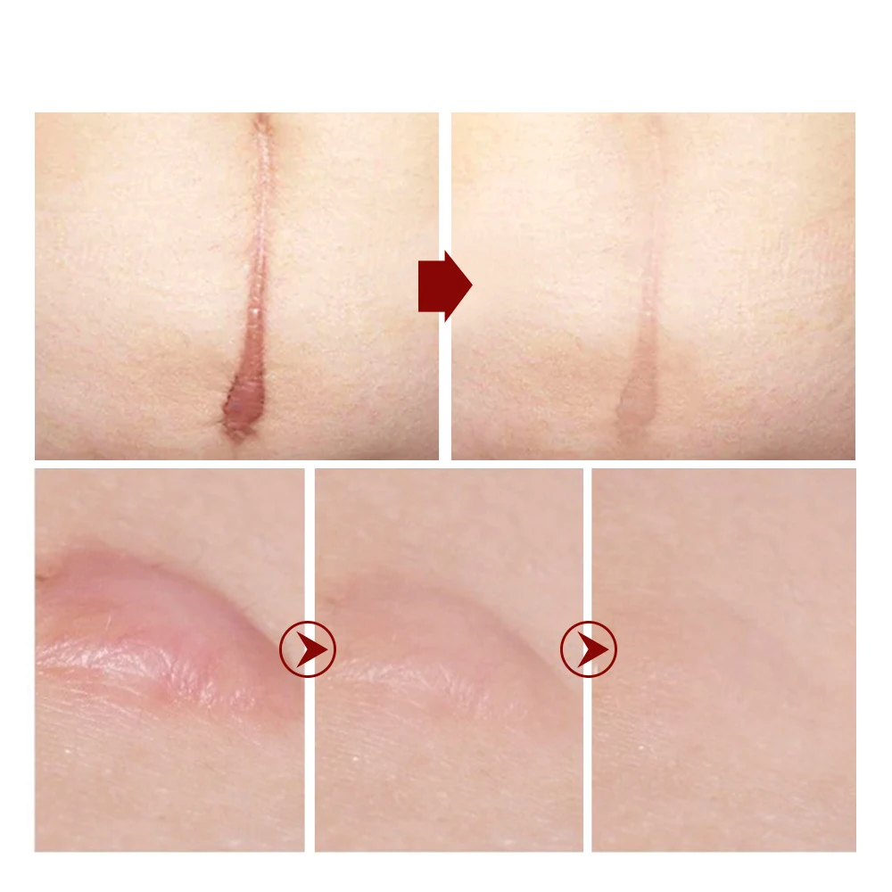 Крем против акне для удаления шрамов ремонт очистки пор и отбеливания