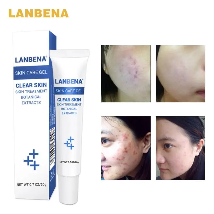 LANBENA крем от акне для лечения средство удаления черных точек пятен