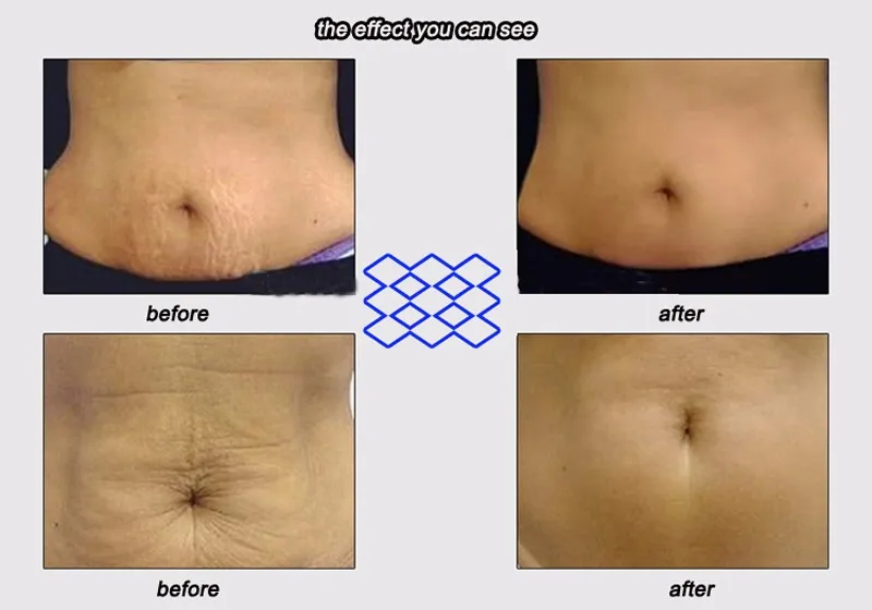 2 шт Таиланд Pasjel для беременных растяжек крем удаления шрамов мощный