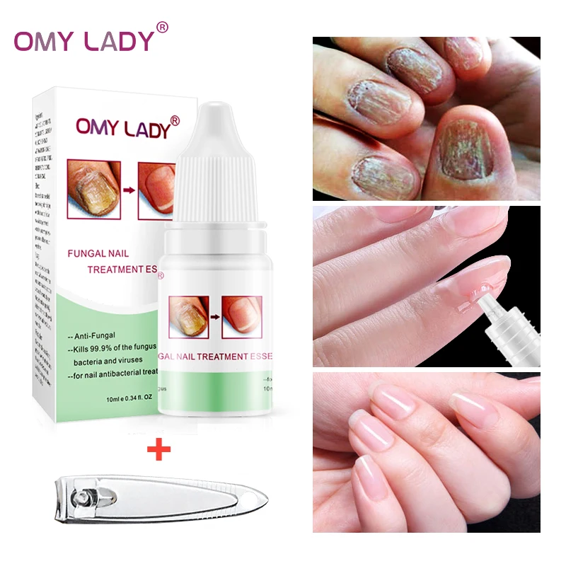 OMYLADY Лечение ногтей от грибка Essence Toe анти грибок для инфекции уход восстановление