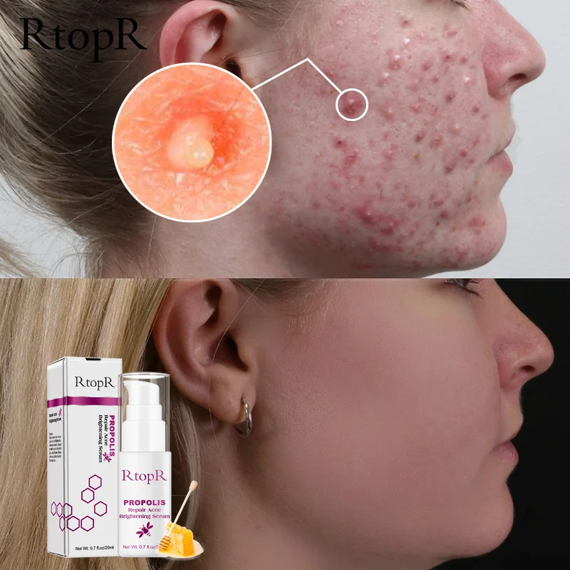 Propolis Acne VC Улитка Гиалуроновая кислота Коллаген Золото полипептид против морщин укрепляющий яркий прополис акне ремонт пор масло контроль пор сыворотка - Вес нетто: Propolis Acne