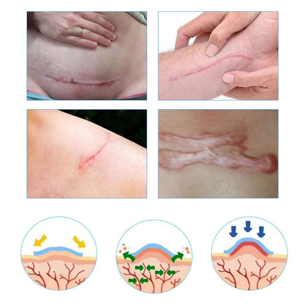 Reusable Silicone Scar Removal Patch Acne Gel Therapy Patch Remove Trauma Burn Sheet Body Skin Care Tools Scar Removal Patch