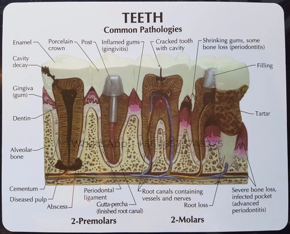 

NEW Denture Teeth model common pathologies teaching model ,Teeth Whitening Tooth Dentist for Medical Science Teaching