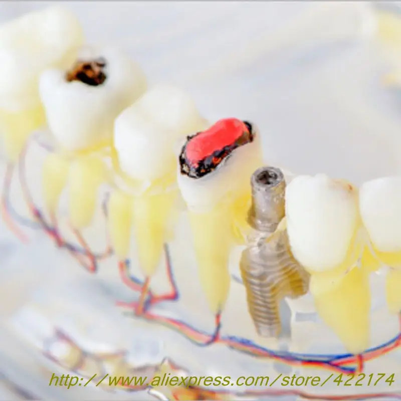

Dental Adult pathological model With tooth nerve With inlay restoration