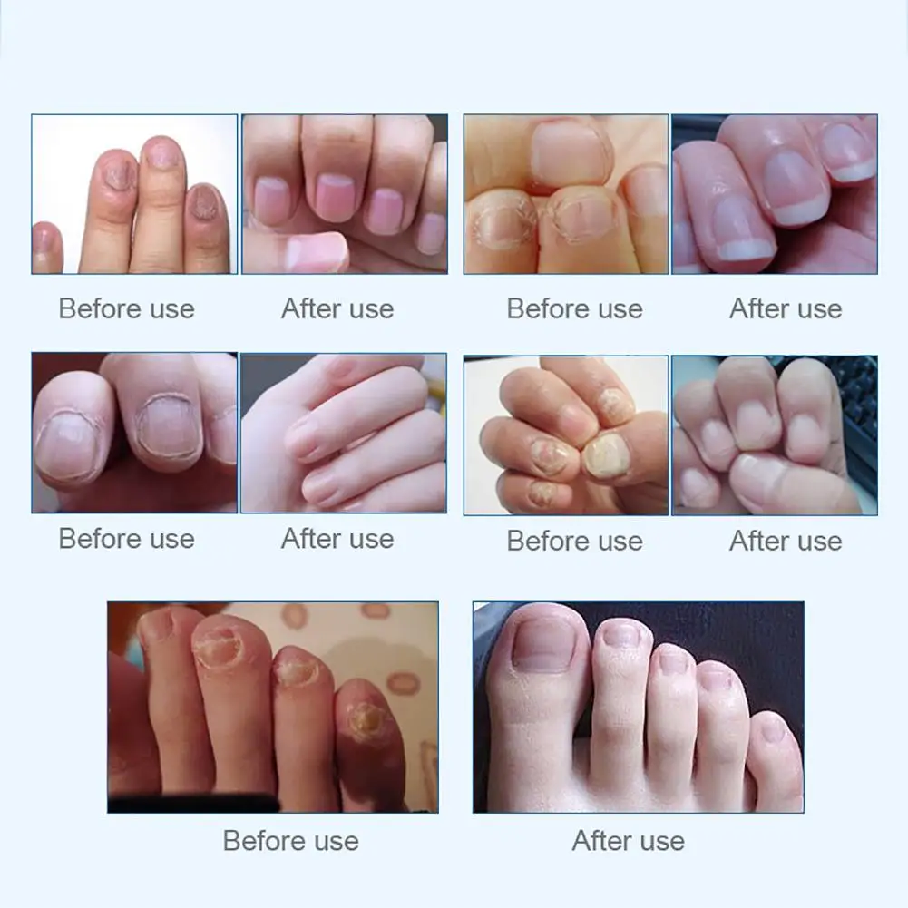 3 мл * 4 Лечение ногтей от грибка эссенция для отбеливающий носок удаление Уход за