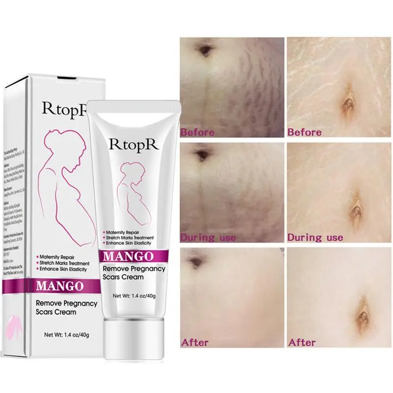 Mango Remove Pregnancy Scars Acne Cream Stretch Marks Treatment Maternity Repair Anti-Aging Winkles Firming Body | Красота и здоровье
