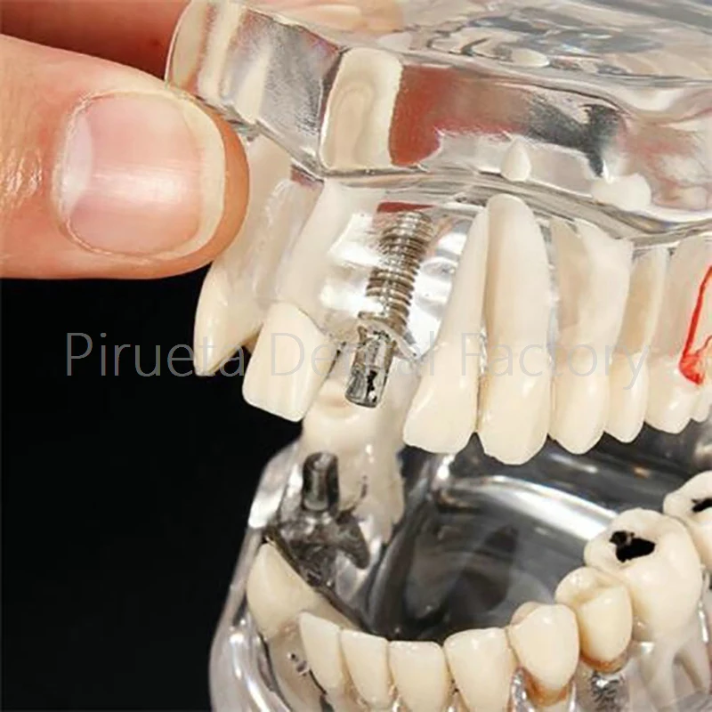 1 модель зубного имплантата с реставрацией моста Ортодонтическая Malocclusion для